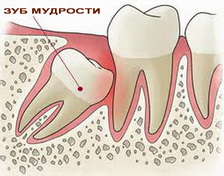 Стоматологи Вива-Дент: 'При наличии показаний зубы мудрости следует удалять'